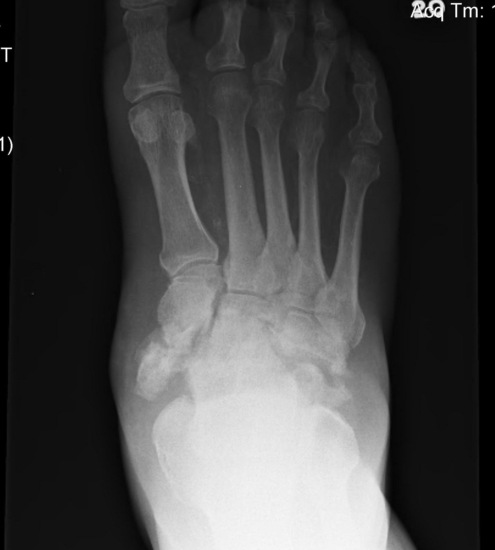 Charcot Foot AP